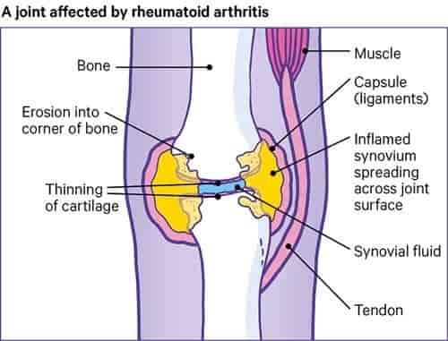 A Joint Affected by Rheumatoid Arthritis