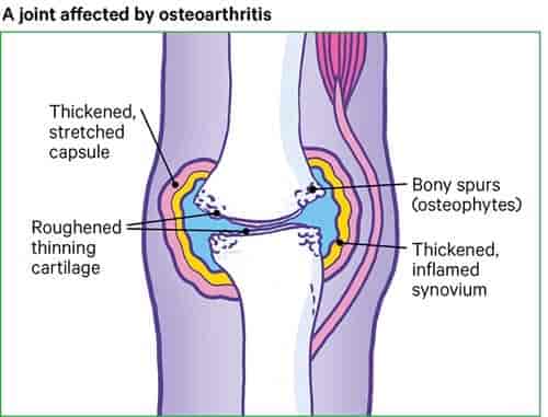 A Joint Affected by Osteoarthritis