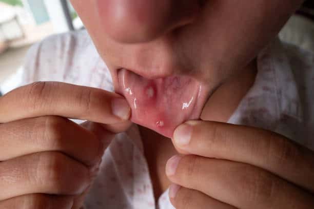 Foods that Cause Mouth Ulcers: There are many things that cause these canker sores. Anxiety, stress, biting the inside of your cheek, and smoking
