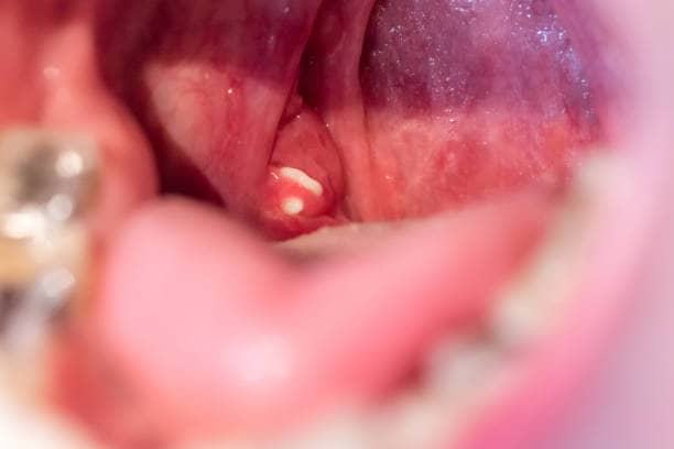 How to Remove Tonsil Stones at Home: Using a toothbrush or cotton swab, carefully scrape them off is the best method. Gargling or using a water pick.