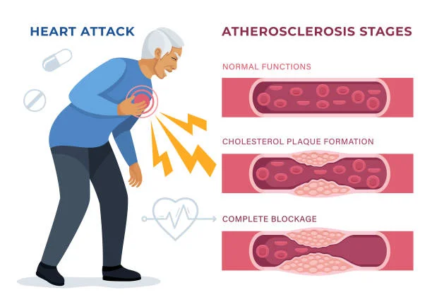 Symptoms of High LDL Cholesterol: High LDL cholesterol, often dubbed "bad cholesterol," is a significant risk factor for heart disease and stroke.