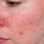 How to Treat Rosacea: Symptoms, Medical & Home Remedies