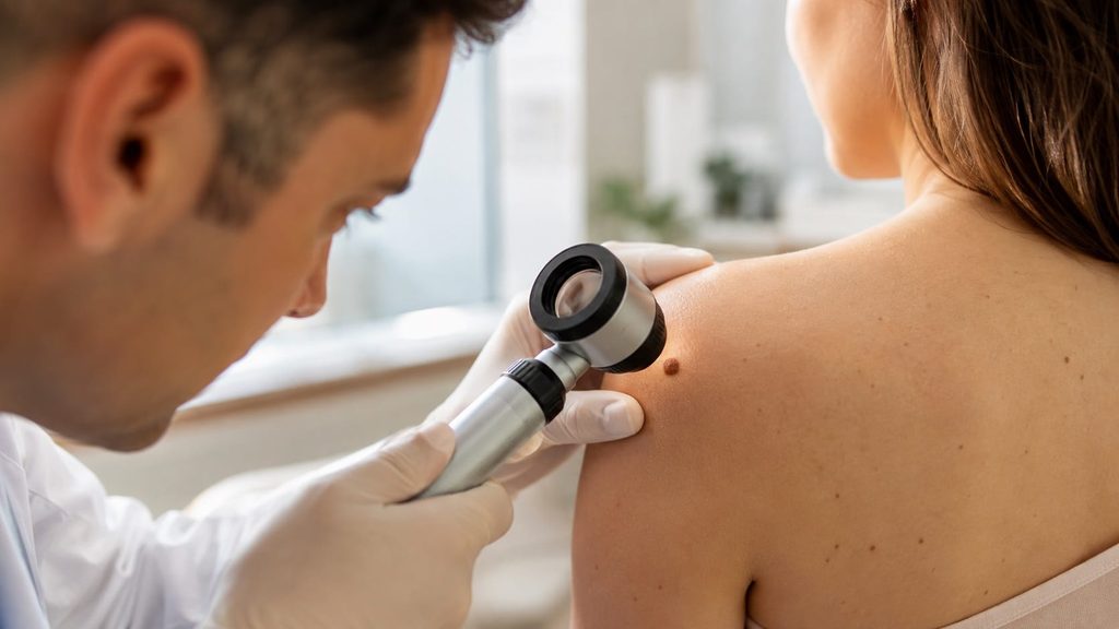 Dermatologist using a dermatoscope to examine a mole on a patient's shoulder for skin cancer warning signs