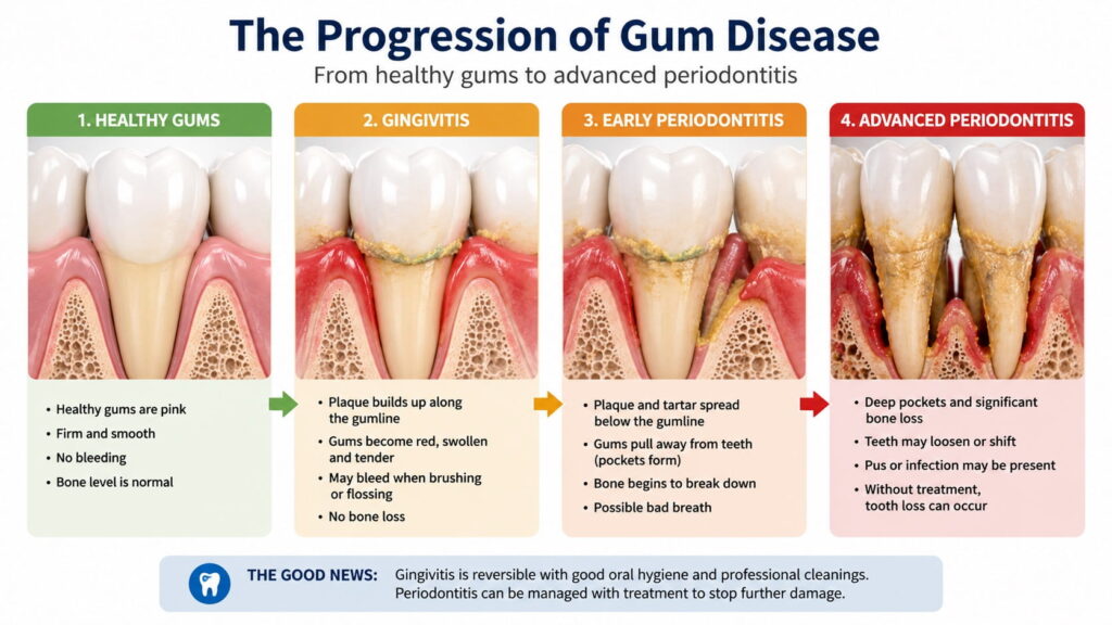 Diagram illustrating the progression from healthy gums to gingivitis and advanced periodontitis.