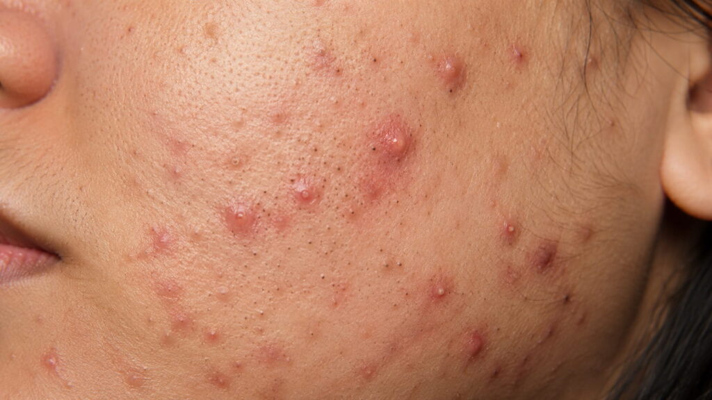 Acne skin condition showing inflamed papules, pustules, and blackheads