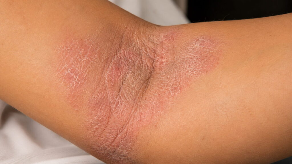 Eczema showing dry, cracked, red patches of skin