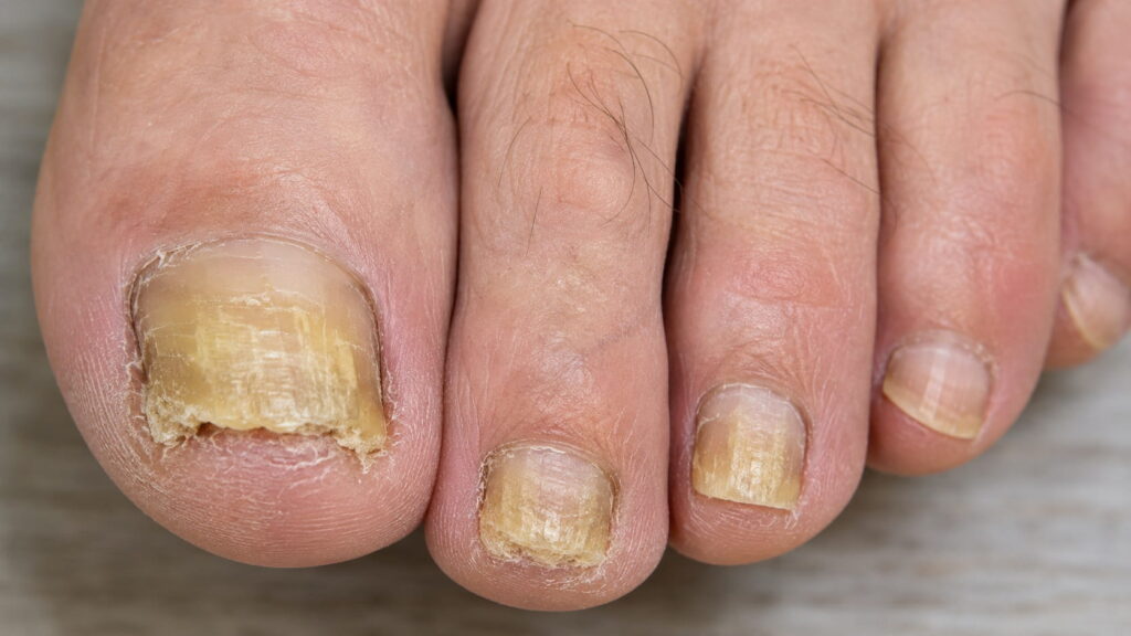 Fungal nail infection showing thickened, yellow nails