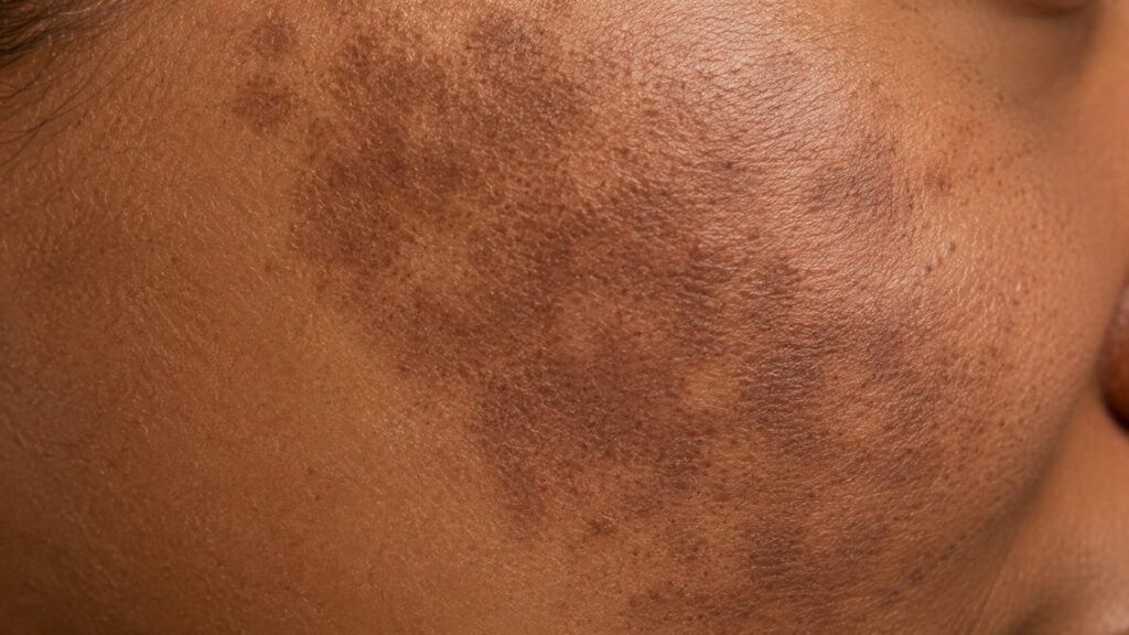 Post-inflammatory hyperpigmentation — showing darkened skin patches after inflammation or injury