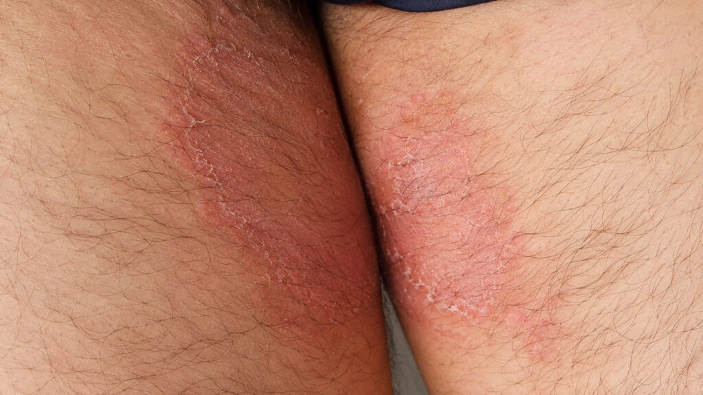 Jock itch showing a red rash in the groin area