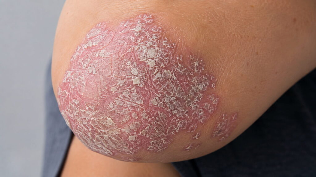Psoriasis showing thick, scaly plaques with silvery scale