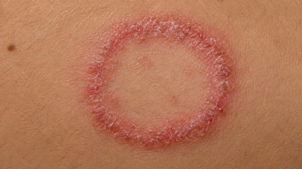 Ringworm showing a red, ring-shaped, scaly rash