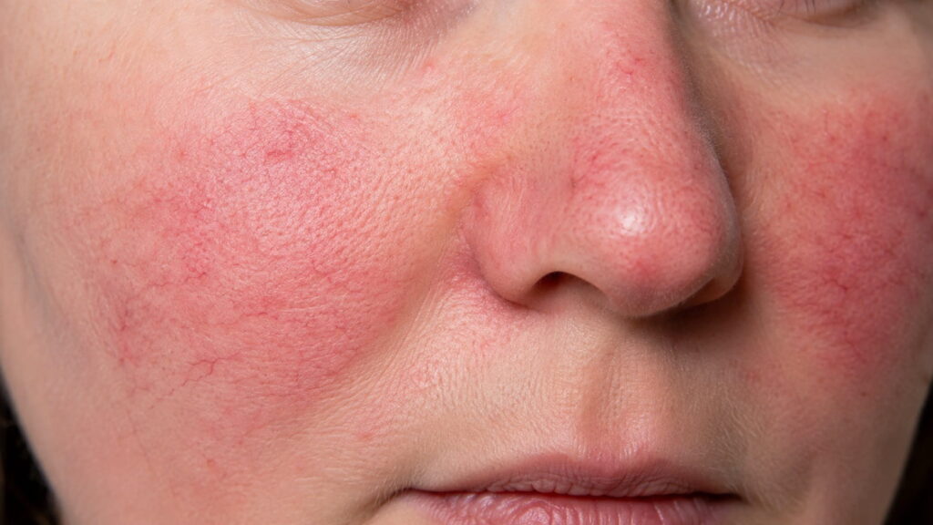 Rosacea showing facial redness and visible blood vessels