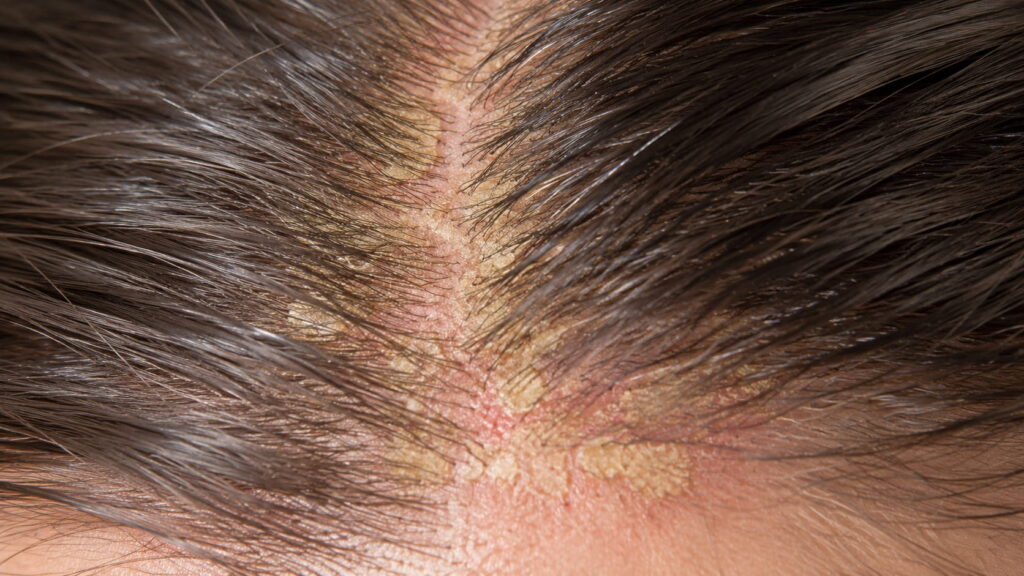Seborrheic dermatitis on the scalp — showing greasy, yellow scaling on the scalp