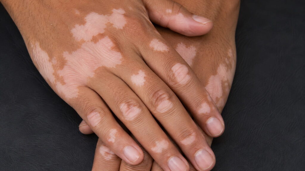 Vitiligo patches on the hands — showing smooth, depigmented white patches on the skin