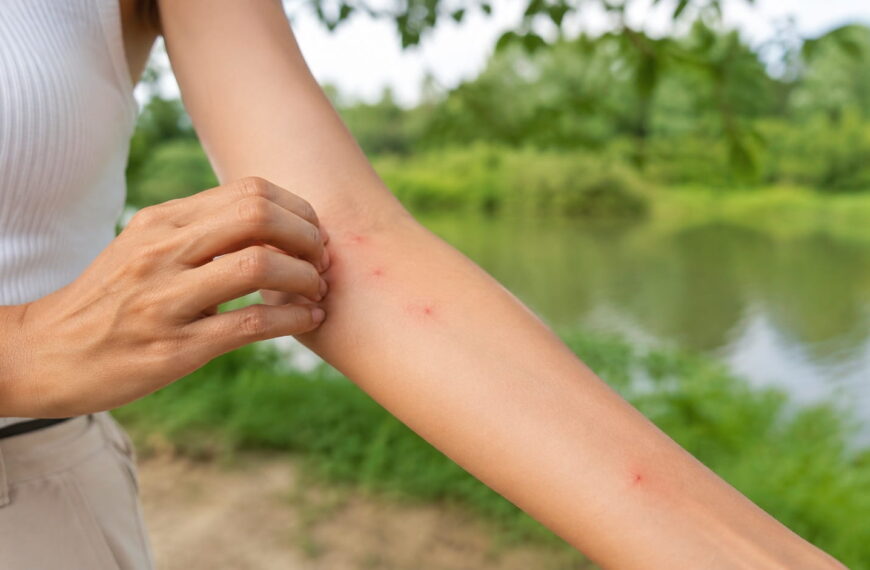How to stop mosquito bites from itching fast on irritated skin